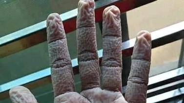 Así quedan las manos de un doctor tras pasar 10 horas con los guantes puestos