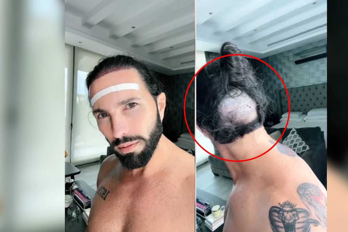 Poncho de Nigris muestra el gran hoyo que tiene atrás de su cabeza por la alopecia