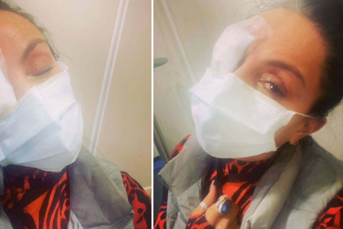 Ivonne Montero sufre accidente y se lastima un ojo