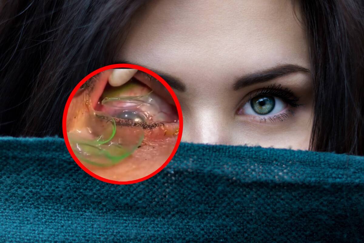 VIDEO: Mujer tenía escondidos más de 20 lentes de contacto en su ojo
