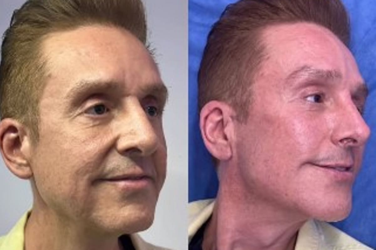 Daniel Bisogno se hace arreglito estético en la cara para verse de 16 años