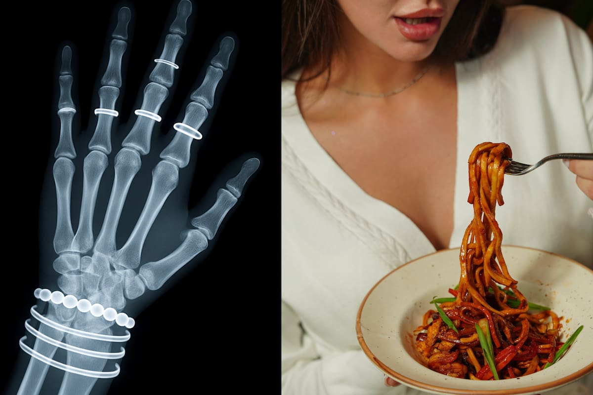 ¿Por qué algunas personas sufren fracturas óseas con mayor frecuencia? Lo que revela la ciencia