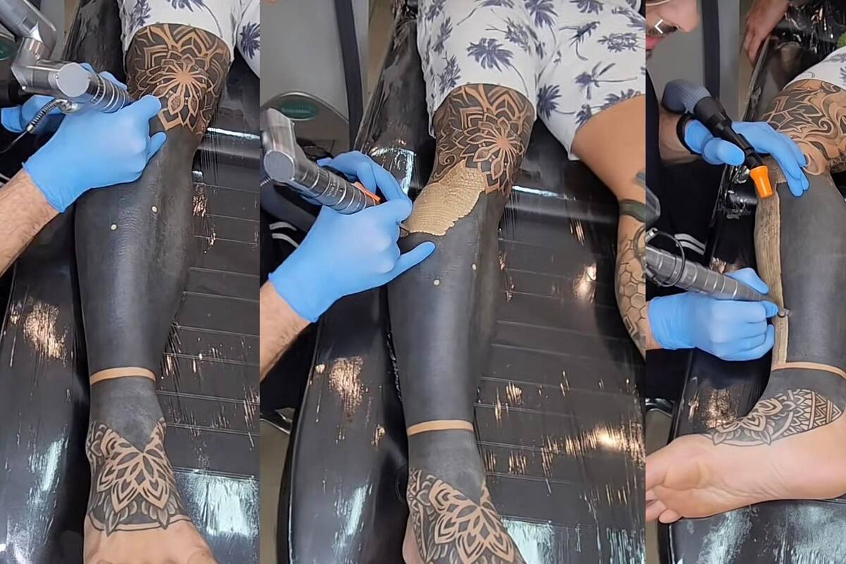 Sujeto presume cómo quedó su pierna tras removerse un tatuaje 'black out'; le cubría toda la zona