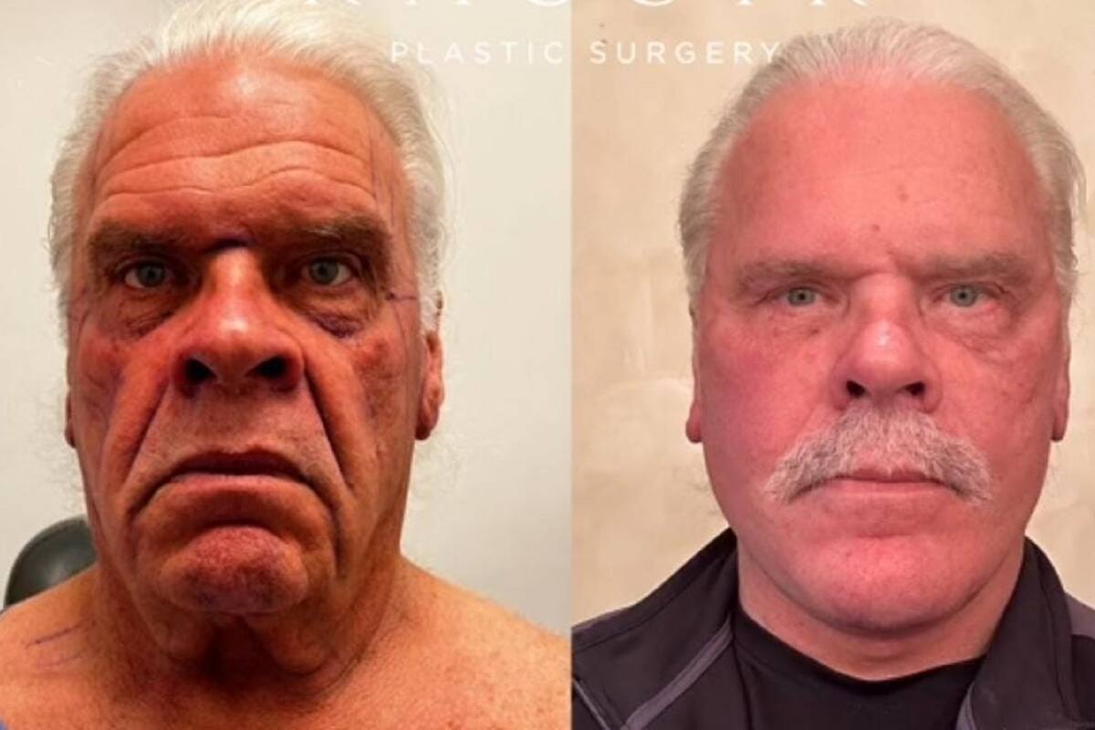 TikTok: Sujeto impresiona a internautas tras su cirugía de rejuvenecimiento