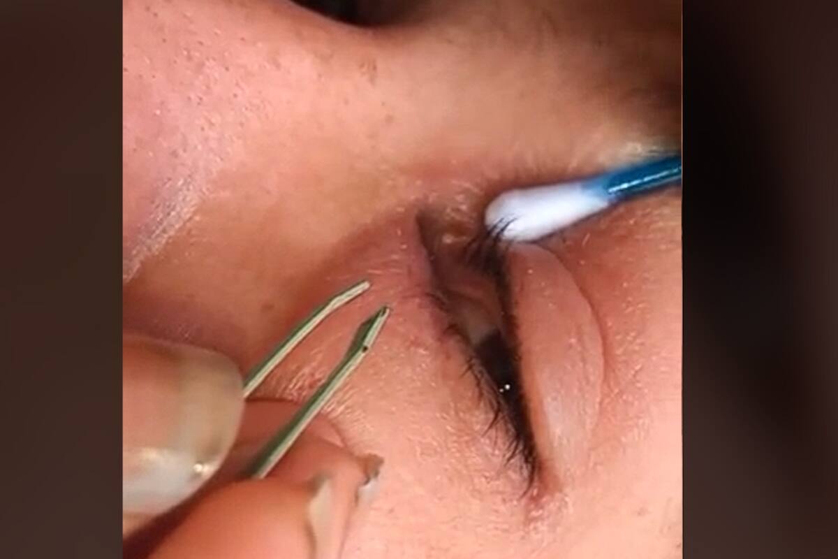 TikTok: Mujer comparte video de cómo le sacan un gusano del ojo