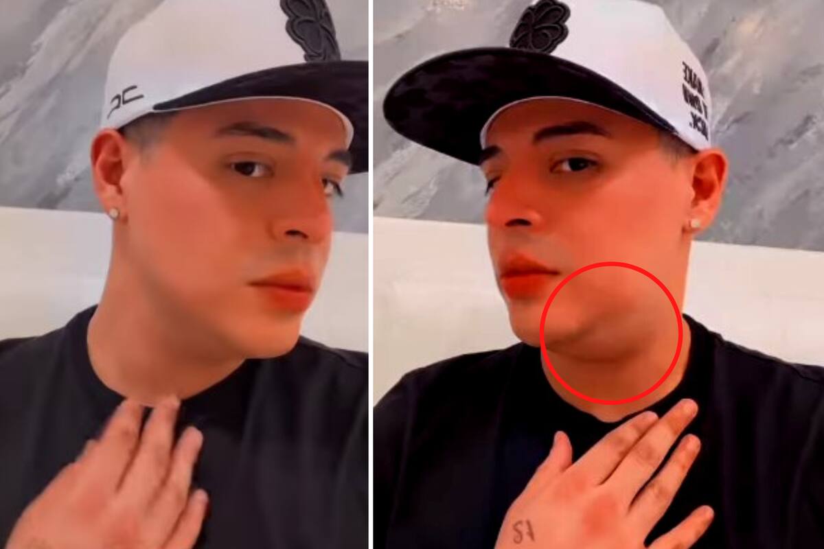 Eduin Caz alarma a sus fans al mostrar que le salió una bola en el cuello