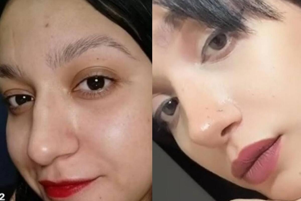 Joven muestra su sorprendente cambio de apariencia tras someterse a una rinoplastia