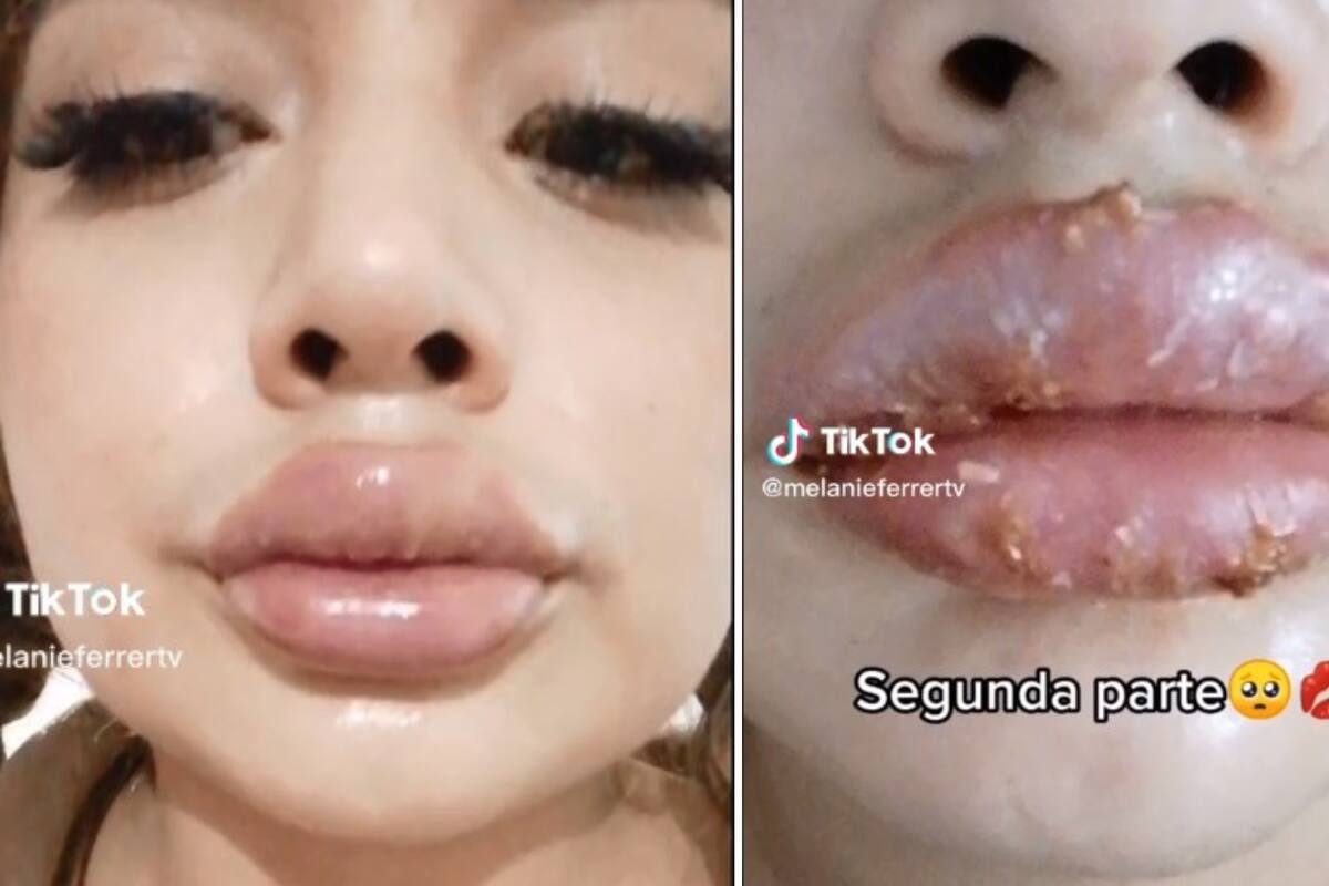 VIDEO DE TIKTOK: ¡Le inyectaron otra cosa! Joven casi pierde sus labios al intentar verse bonita