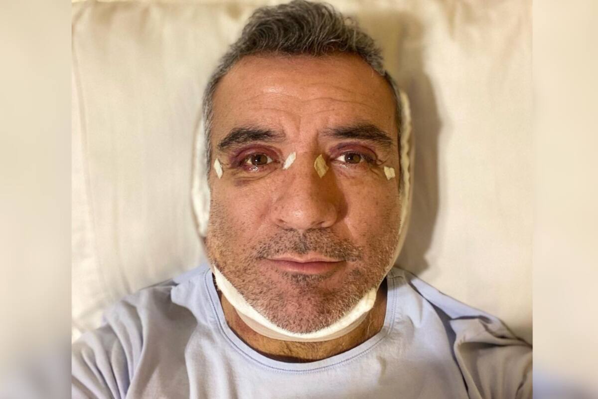 ¡Héctor Sandarti sorprende a todos al hacerse una cirugía estética!